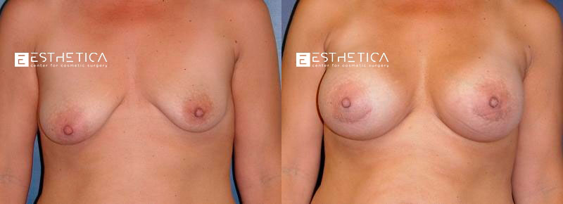 Breast Lift before and after — Case #3204