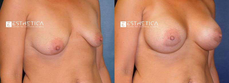 Breast Lift before and after — Case #3207