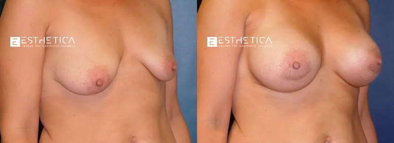 Breast Lift before and after — Case #3207