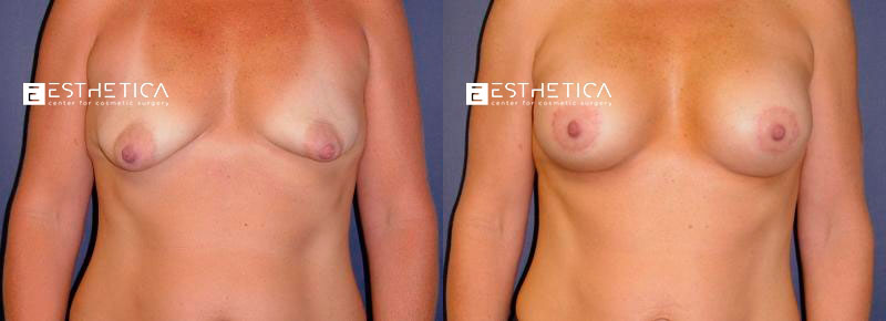 Breast Lift before and after — Case #3223