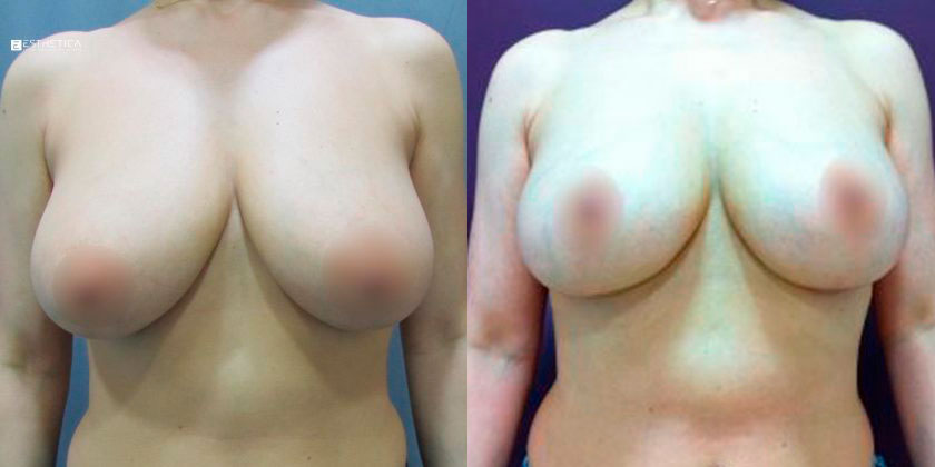 Breast Lift before and after — Case #3497