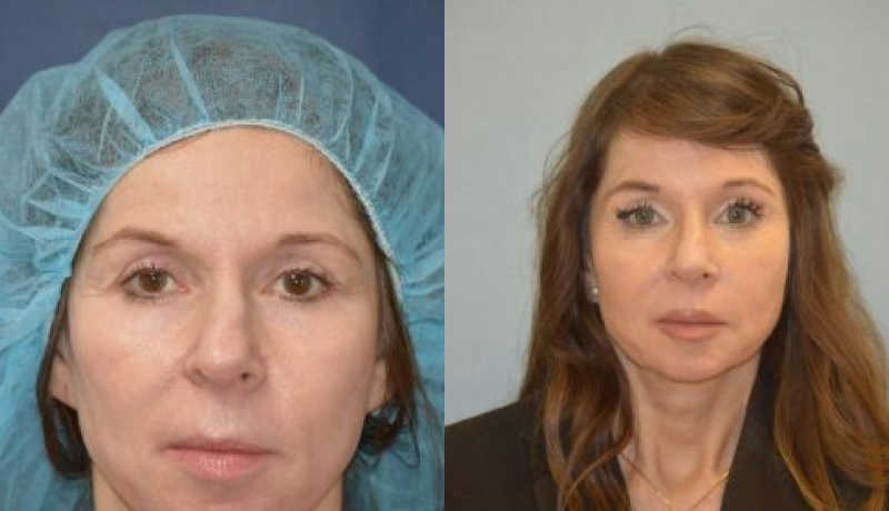 Brow Lift before and after — Case #2959