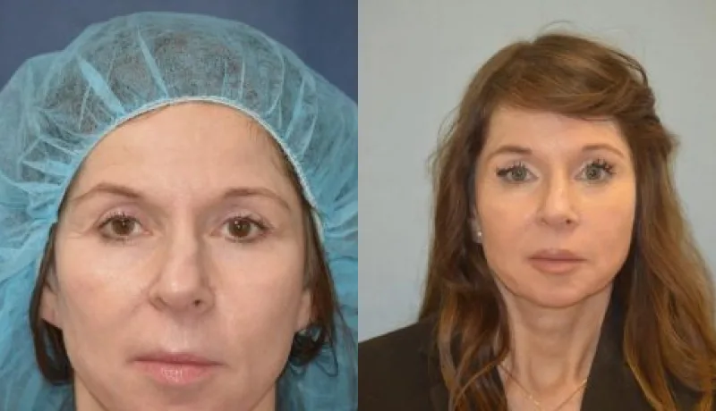 Brow Lift before and after — Case #2959