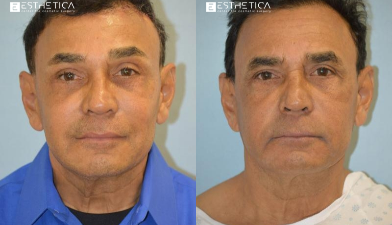 Brow Lift before and after — Case #3513