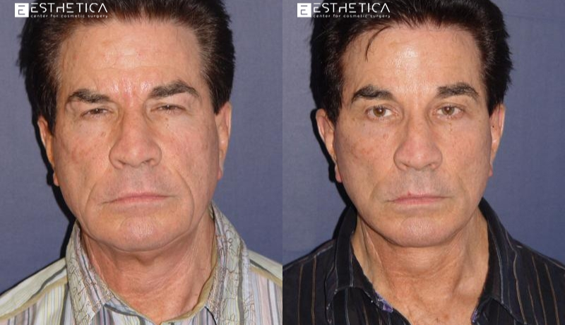 Brow Lift before and after — Case #3518