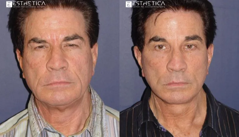 Brow Lift before and after — Case #3518
