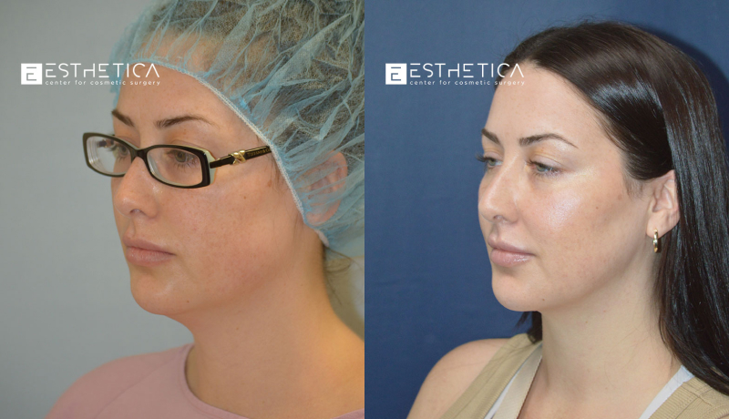 Facelift before and after — Case #2905
