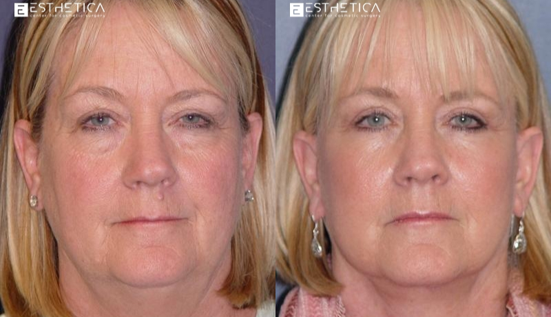 Facelift before and after — Case #2907
