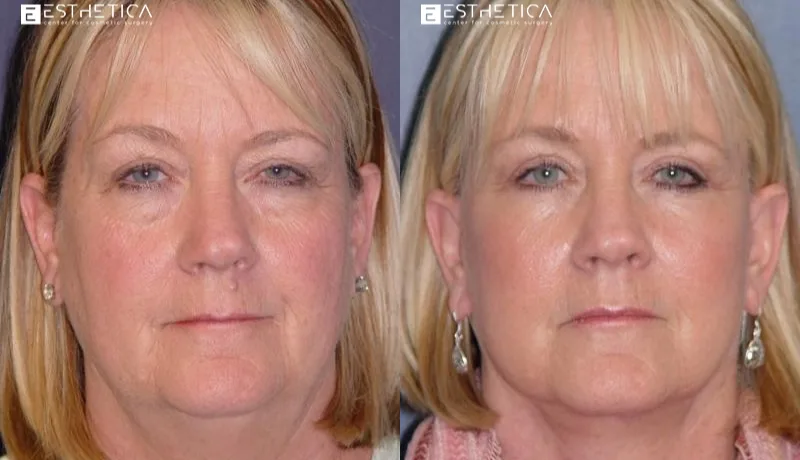 Facelift before and after — Case #2907