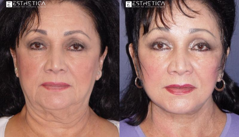 Facelift before and after — Case #2919