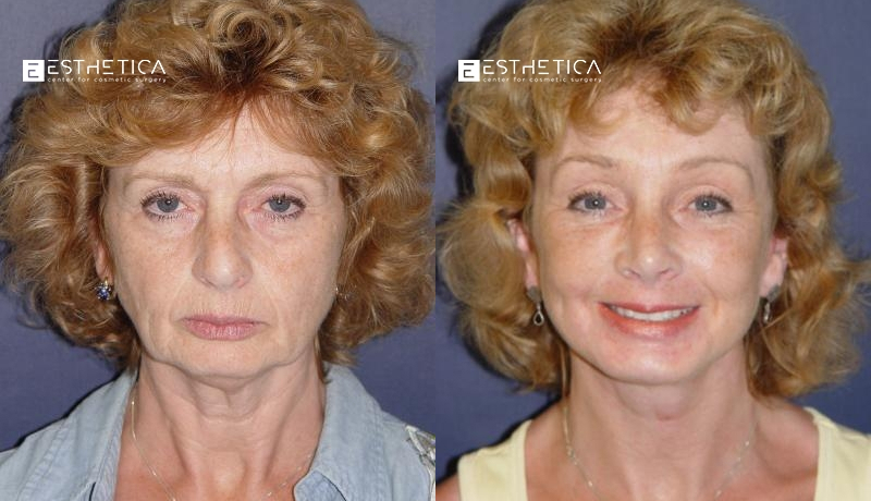 Facelift before and after — Case #2926