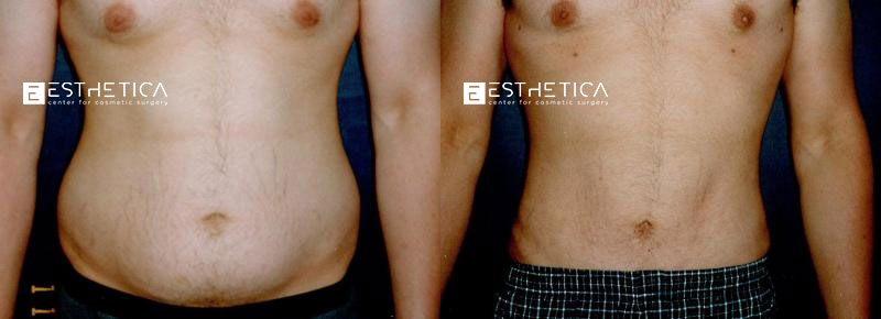 Liposuction before and after — Case #3525