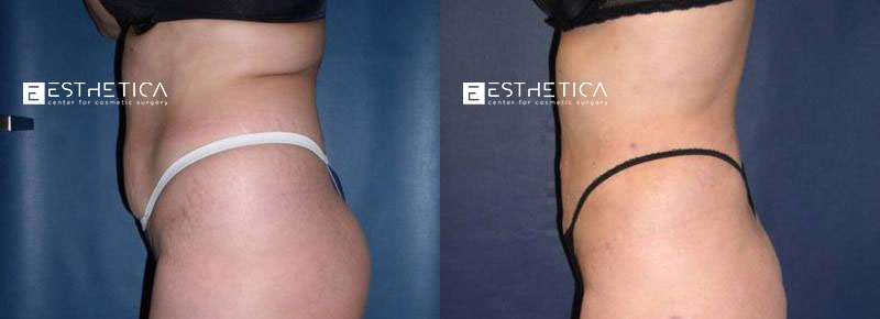 Liposuction before and after — Case #3693