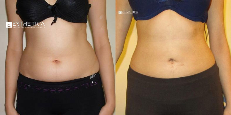 Liposuction before and after — Case #3717