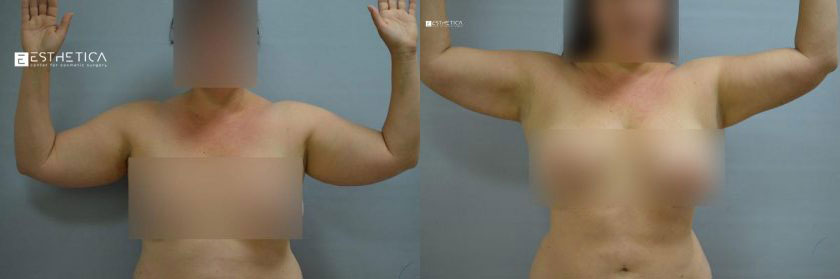 Liposuction before and after — Case #3720