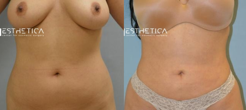 Mommy Makeover before and after — Case #3705