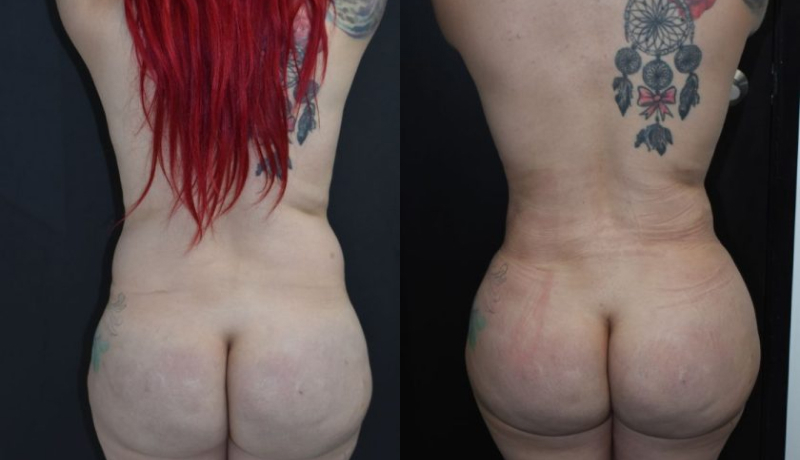 Mommy Makeover before and after — Case #4422