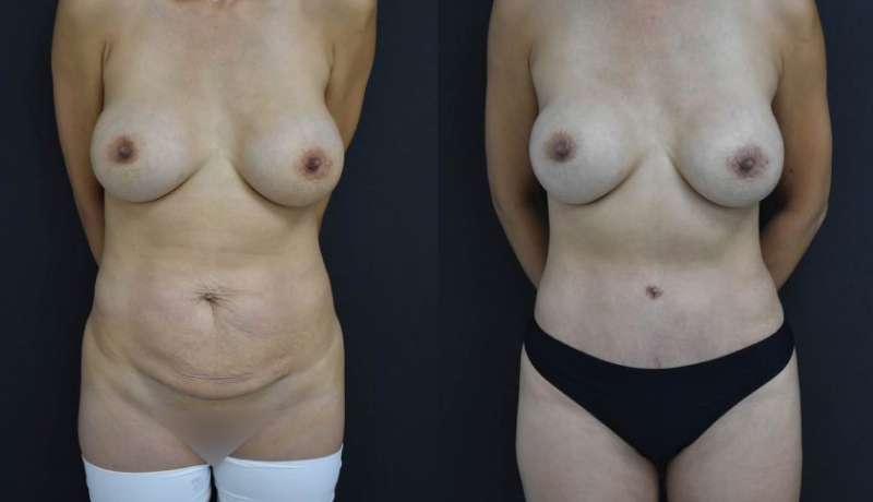 Mommy Makeover before and after — Case #4481
