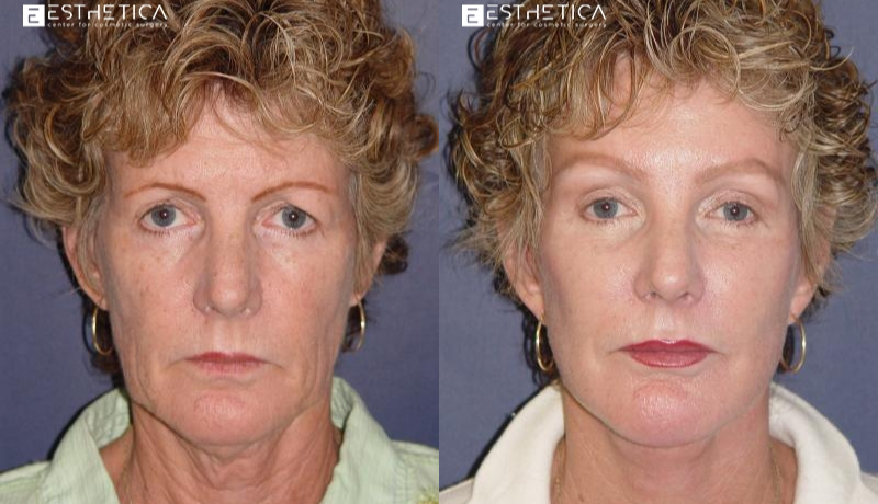 Neck Lift before and after — Case #2887