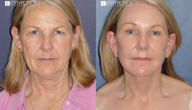 Neck Lift before and after — Case #2892