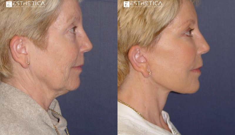 Neck Lift before and after — Case #2897