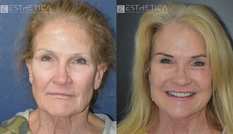 Neck Lift before and after — Case #2899