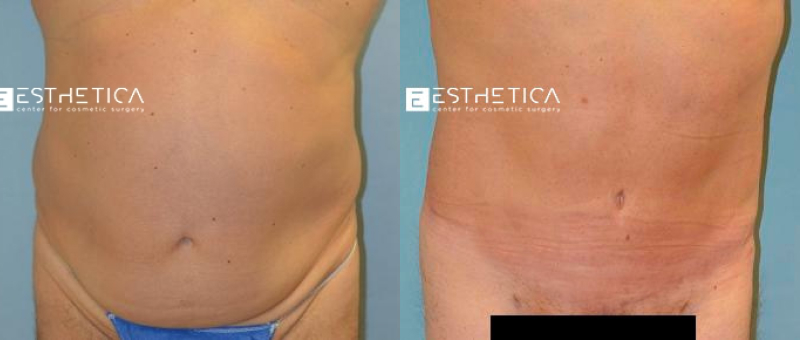 Tummy Tuck before and after — Case #3571