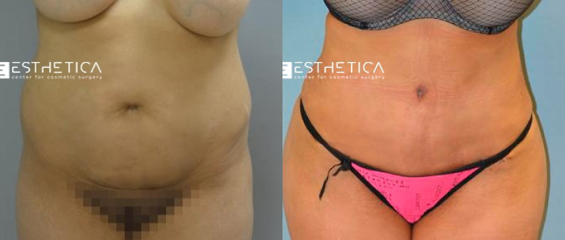 Tummy Tuck before and after — Case #3651