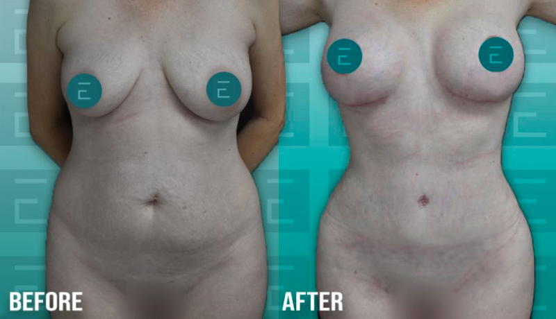 Tummy Tuck before and after — Case #4204