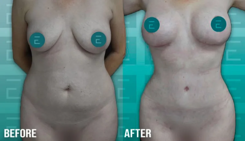 Tummy Tuck before and after — Case #4204