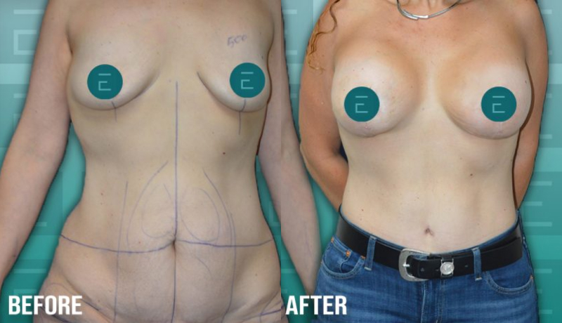 Tummy Tuck before and after — Case #4206
