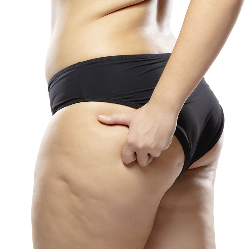 Liposuction